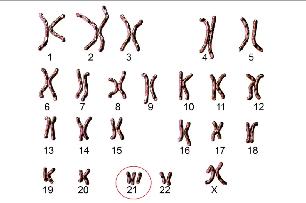 Tam nhiễm sắc thể 21 (hội chứng Down) Tam nhiễm sắc thể 21 (hội chứng Down)