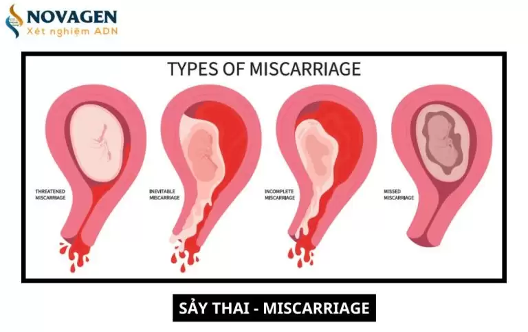 Sảy thai là gì? Nguyên nhân, triệu chứng và cách điều trị