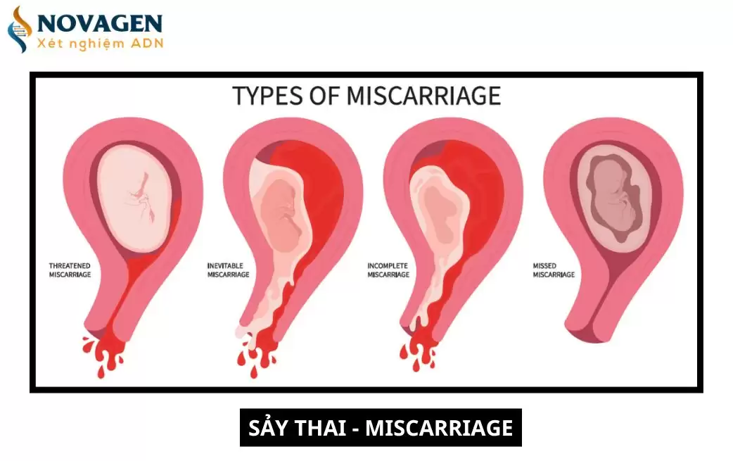 Sảy thai là gì? Nguyên nhân, triệu chứng và cách điều trị