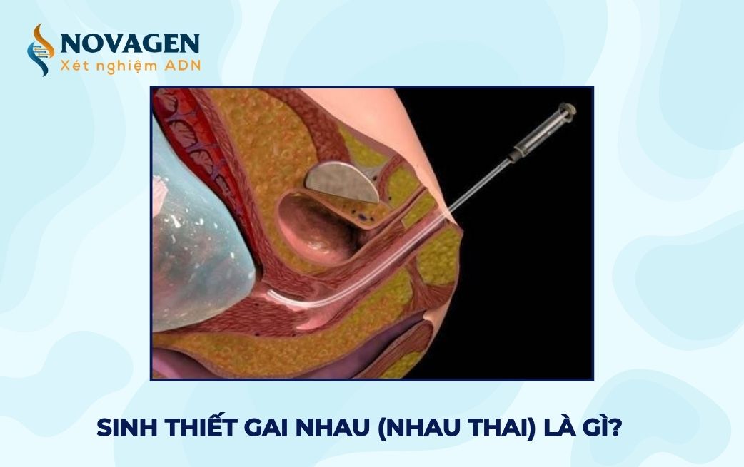 Sinh thiết gai nhau hay sinh thiết nhau thai là gì?