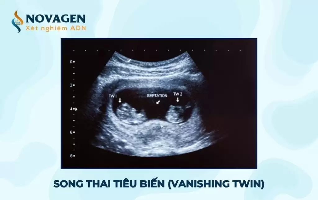 Hội chứng Song thai tiêu biến (Vanishing Twin) là gì? 