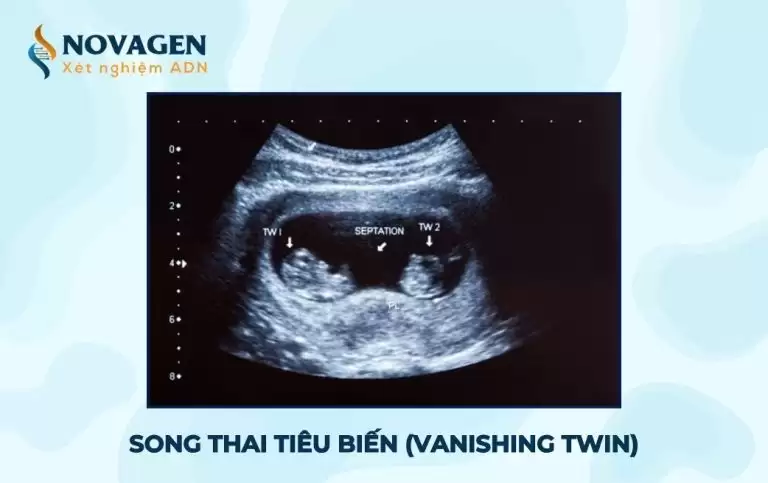 Hội chứng Song thai tiêu biến (Vanishing Twin) là gì? 