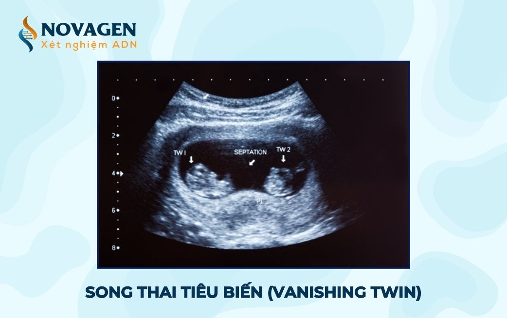 Song thai tiêu biến (Vanishing Twin) là hội chứng gì?