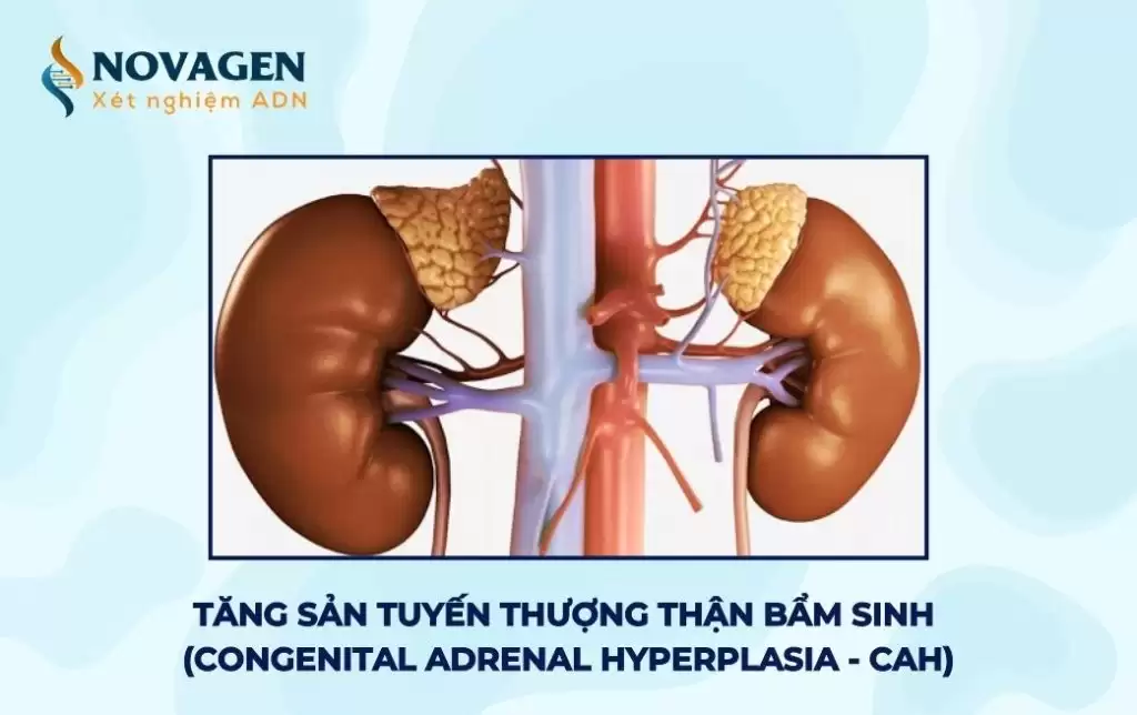 Tăng sản tuyến thượng thận bẩm sinh (Congenital Adrenal Hyperplasia – CAH)