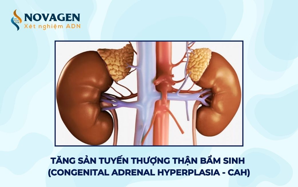 Tăng sản tuyến thượng thận bẩm sinh (Congenital Adrenal Hyperplasia - CAH)