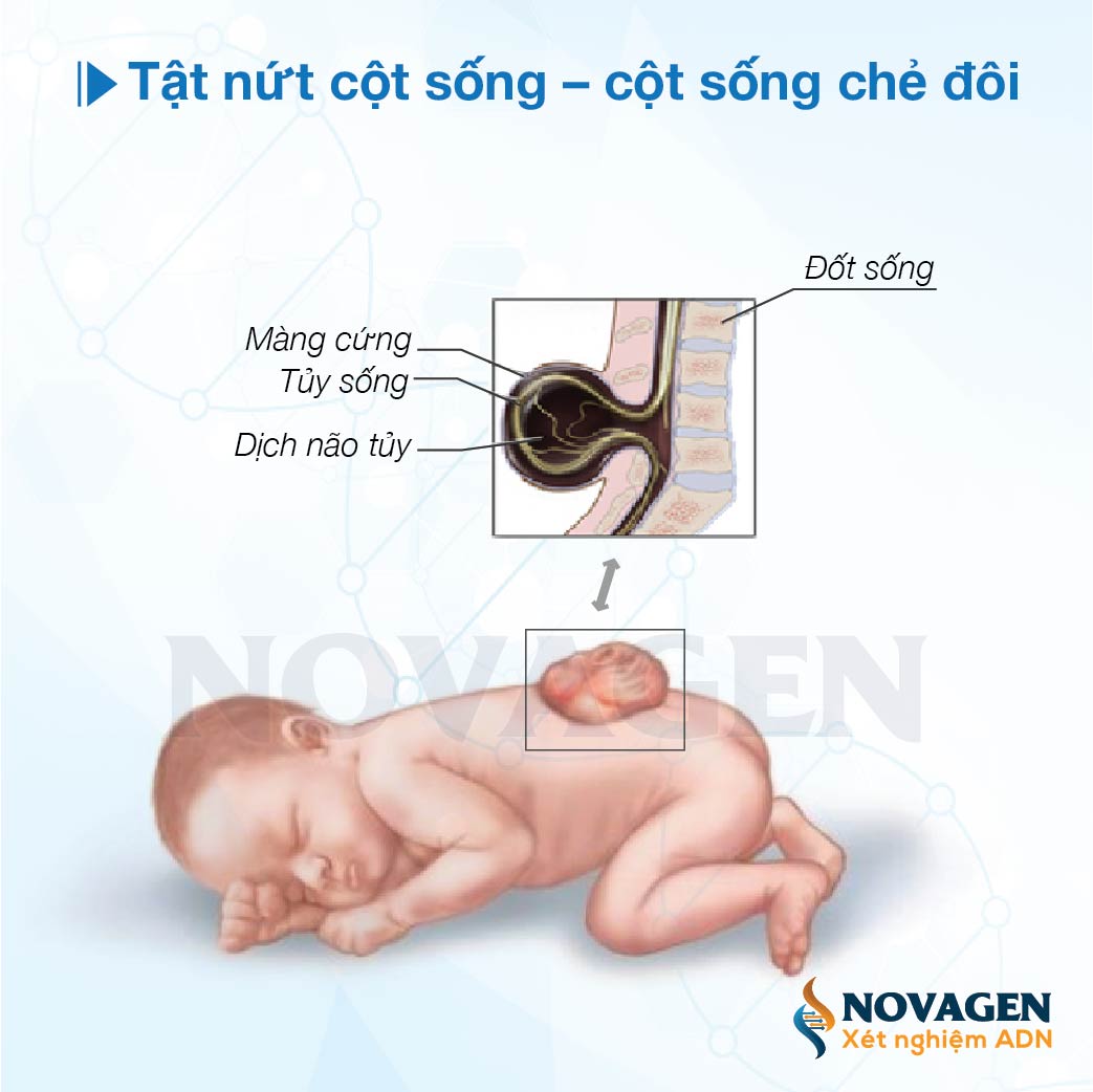 dị tật ống thần kinh