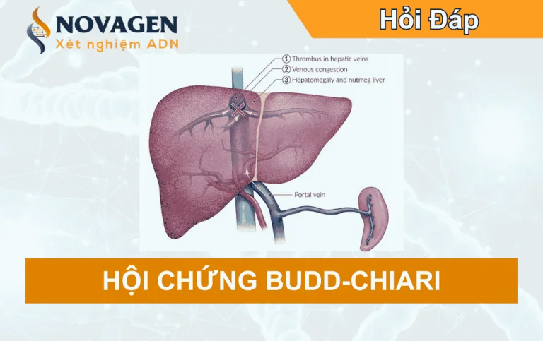 Hội chứng Budd–Chiari: Bệnh lý tắc tĩnh mạch gan hiếm gặp