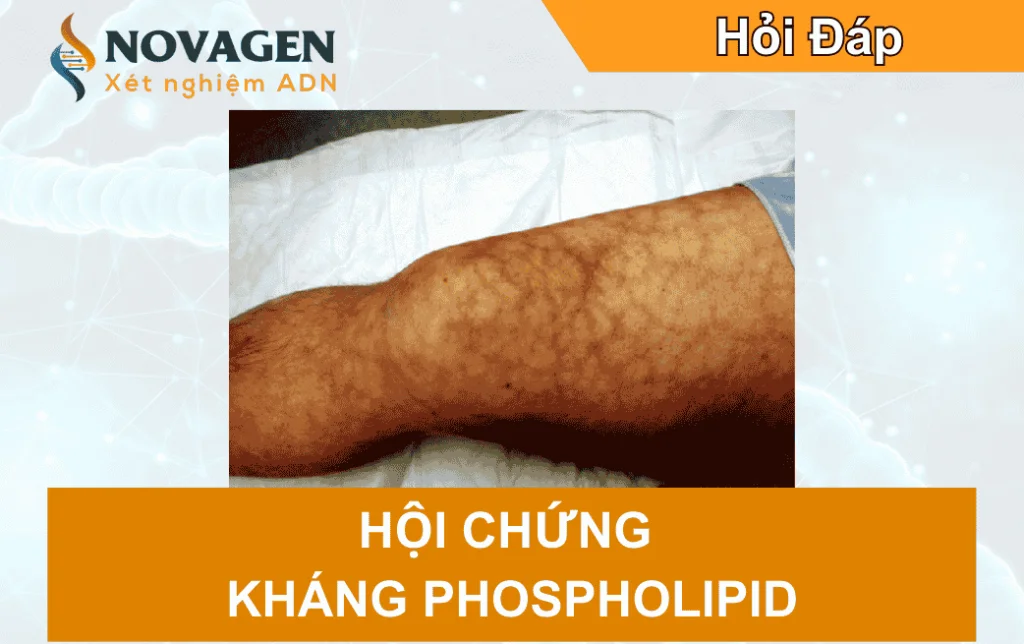 Hội chứng kháng phospholipid: Nguyên nhân, điều trị và phòng ngừa