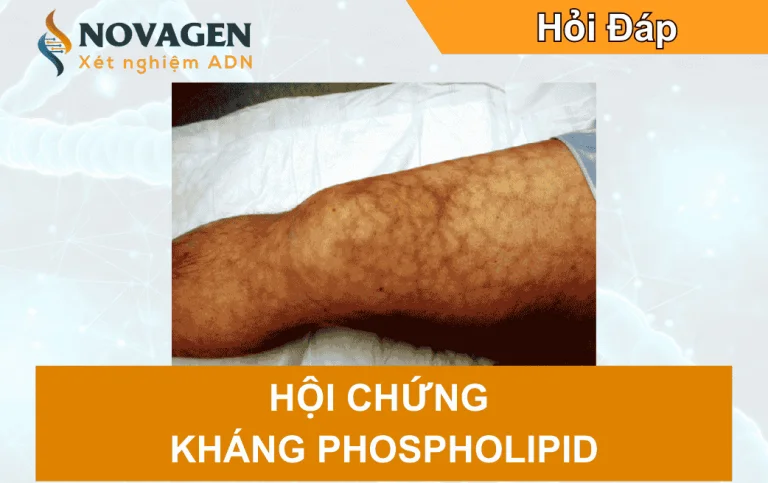 Hội chứng kháng phospholipid: Nguyên nhân, điều trị và phòng ngừa