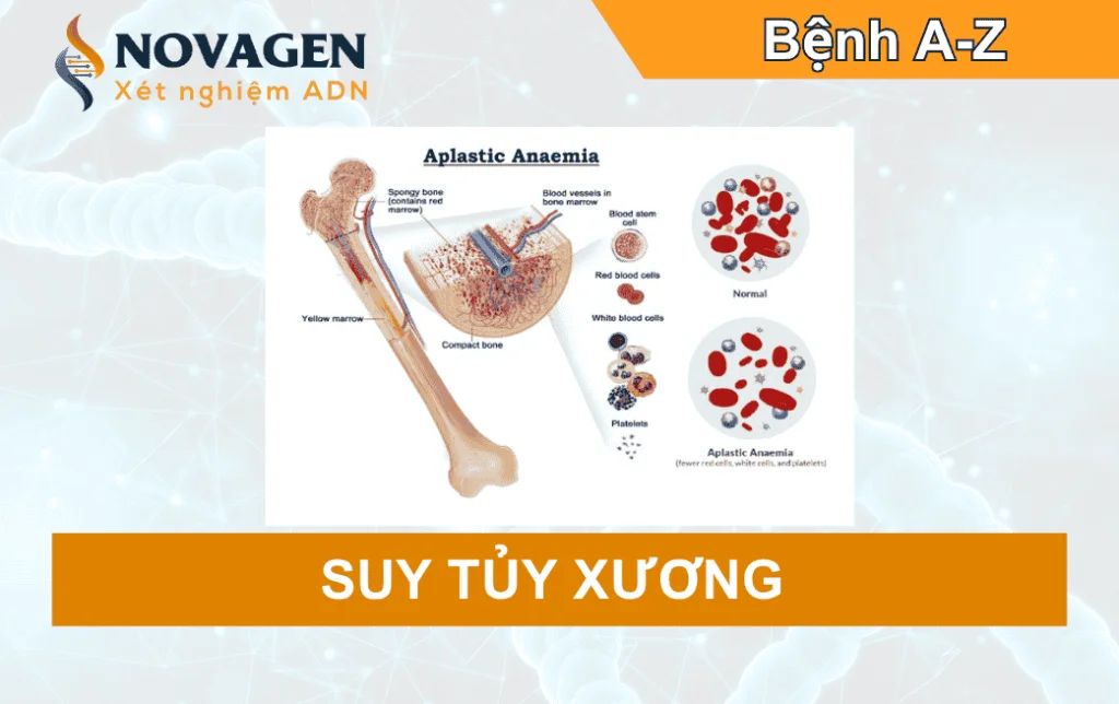 Suy tủy xương
