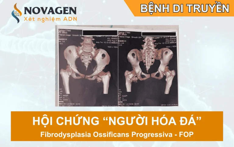 Hội chứng người hoá đá – Từ ca bệnh ở Việt Nam đến bằng chứng y học