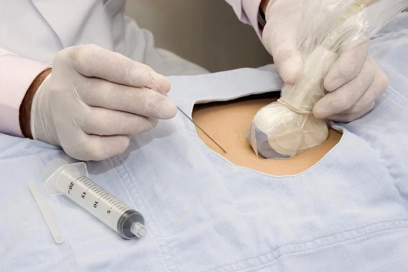 Nguy cơ sảy thai và mất thai từ 0,2 - 2% là rủi ro xét nghiệm ADN trước sinh có xâm lấn